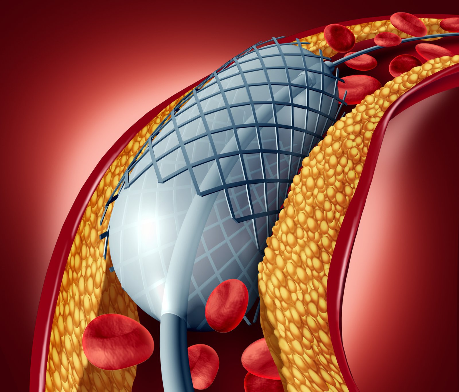 Angiography & Angioplasty